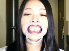 銀歯vs虫歯を発見！ダブル口腔淫診ショー